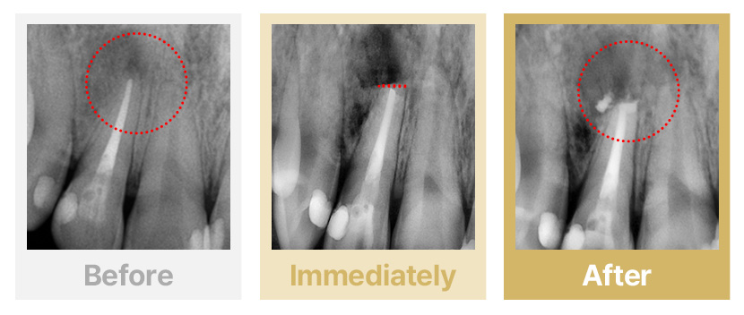 1.신경치료 후 뿌리 끝에 염증이 생긴 경우