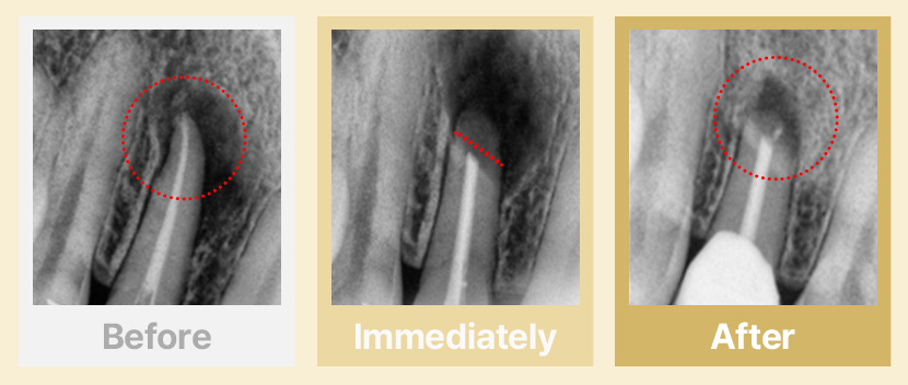 2.신경치료 후 뿌리 끝에 염증이 크게 생긴 경우