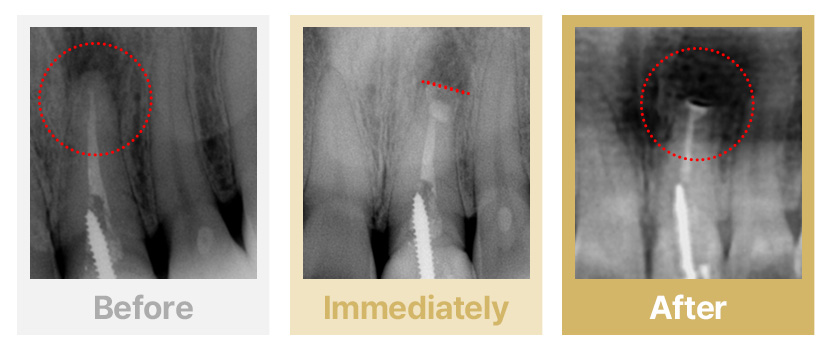3.타병원 신경치료 후 염증이 생긴 치아 신경관이 막혀 치료가 불가능한 경우