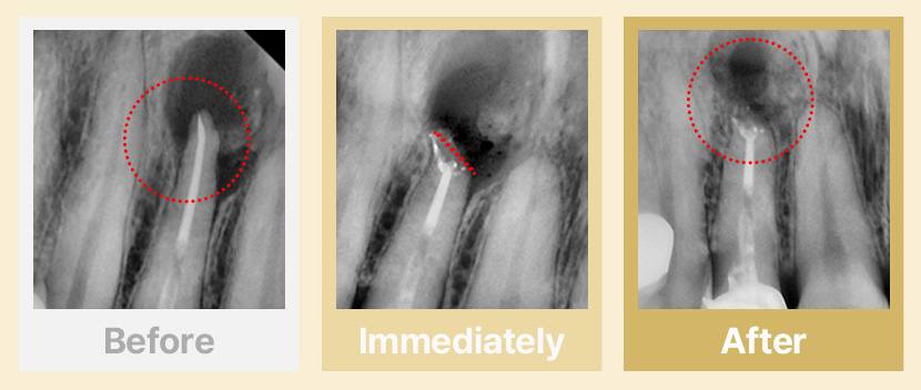 4.타병원 신경치료 후 염증이 크게 생긴 경우