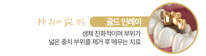 골드 인레이