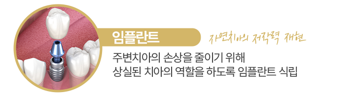 임플란트