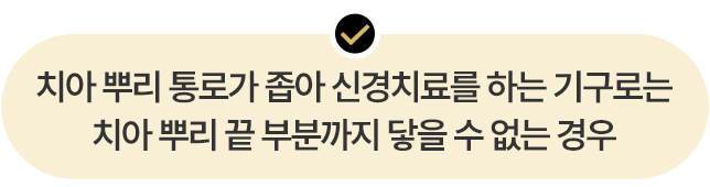 치아 뿌리가 통로가 좁아 신경치료를 하는 기구로는 치아 뿌리 끝 부분까지 닿을 수 없는 경우
