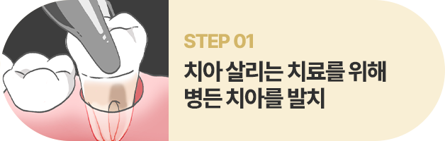 STEP01:치아 살리는 치료를 위해 병든 치아를 발치