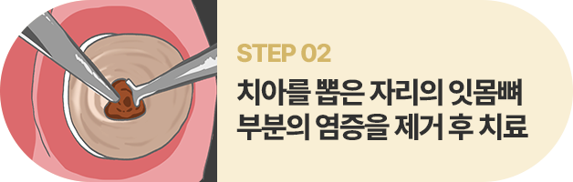 STEP02:치아를 뽑은 자리의 잇몸뼈 부분의 염증을 제거 후 치료