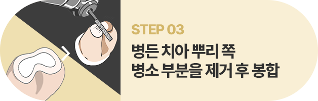 STEP03:병든 치아 뿌리 쪽 병소 부분을 제거 후 봉합