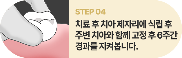 STEP04:치료 후 치아 제자리에 식립 후 주변 치아와 함께 고정 후 6주간 경과를 지켜봅니다.
