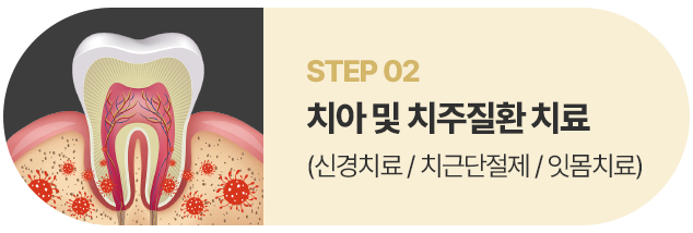 치아 및 치주질환 치료