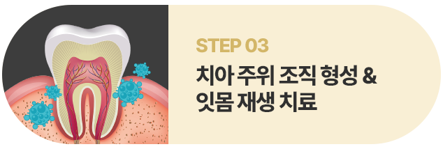 치아 주위 조직 형성 및 잇몸 재생 치료