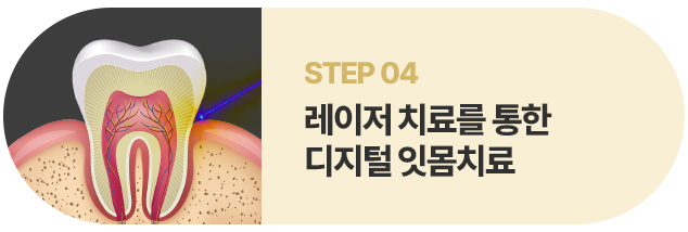 레이저 치료를 통한 디지털 잇몸치료