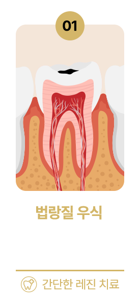 법랑질 우식