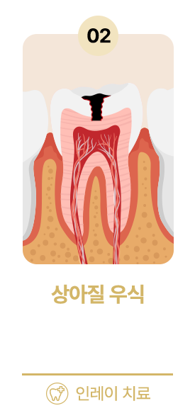 상아질 우식