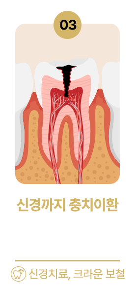 신경까지 충치이환