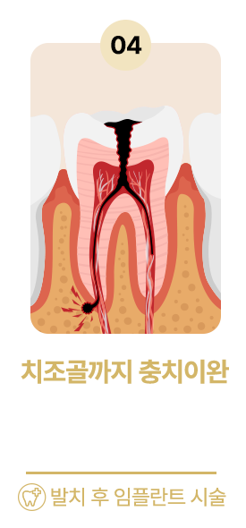 치조로까지 충치이환
