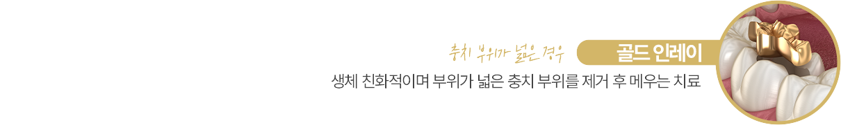 골드 인레이