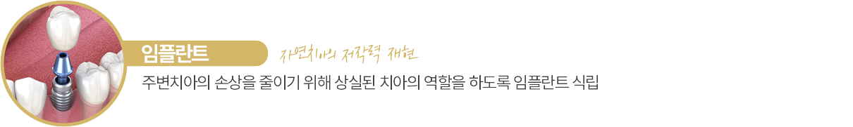 임플란트