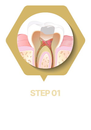 충치 제거 및 치아에 구멍 뚫기