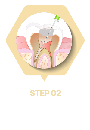 치아 내부 신경과 혈관 제거