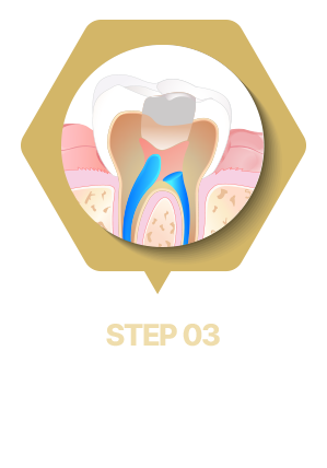 생체 친화적인 대체 재료로 채움