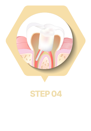 크라운을 씌우면 종료