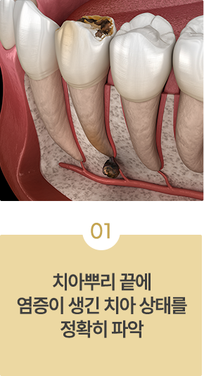 치근단절제술 치료과정01