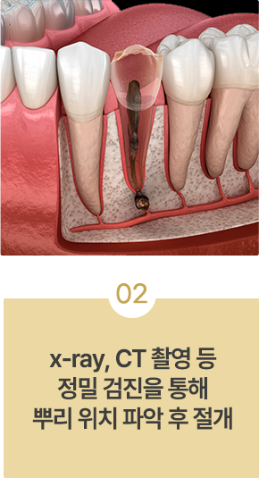 치근단절제술 치료과정03