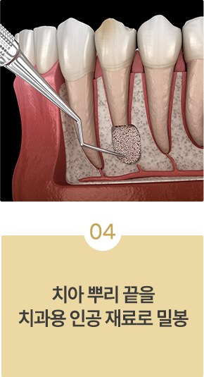 치근단절제술 치료과정04