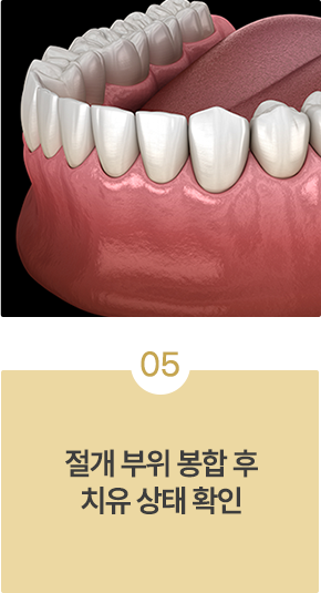 치근단절제술 치료과정05