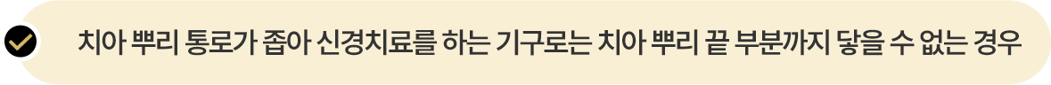 치아 뿌리가 통로가 좁아 신경치료를 하는 기구로는 치아 뿌리 끝 부분까지 닿을 수 없는 경우