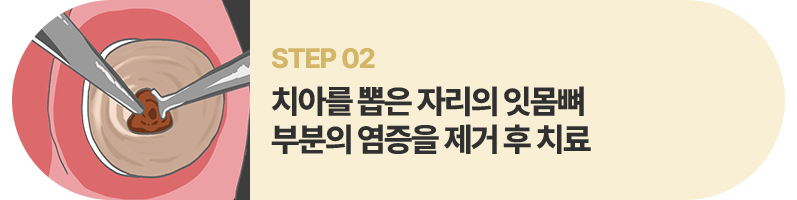 STEP02:치아를 뽑은 자리의 잇몸뼈 부분의 염증을 제거 후 치료