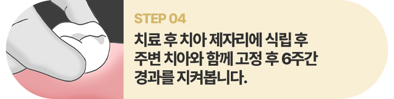 STEP04:치료 후 치아 제자리에 식립 후 주변 치아와 함께 고정 후 6주간 경과를 지켜봅니다.