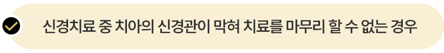 신경치료 중 치아의 신경관이 막혀 치료를 마무리 하 수 없는 경우