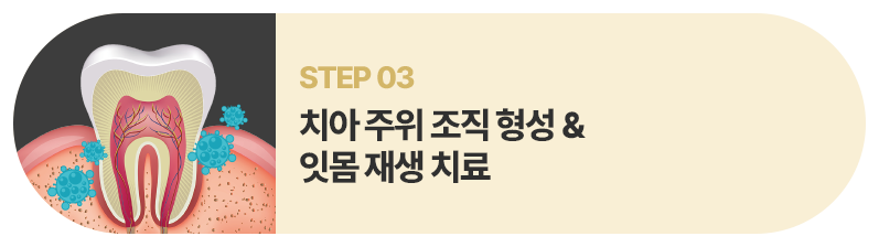 치아 주위 조직 형성 및 잇몸 재생 치료