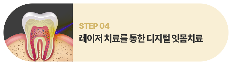 레이저 치료를 통한 디지털 잇몸치료