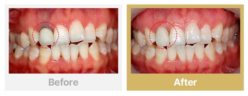 1.오래된 PFM을 올세라믹으로 교체