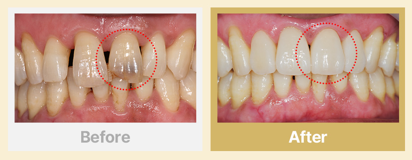 2.깨지고 변색된 치아 시술