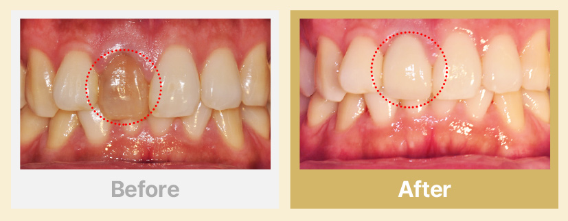 4.변색된 치아 시술