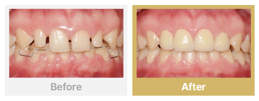 7.벌어진 치아+왜소치 올세라믹 수복