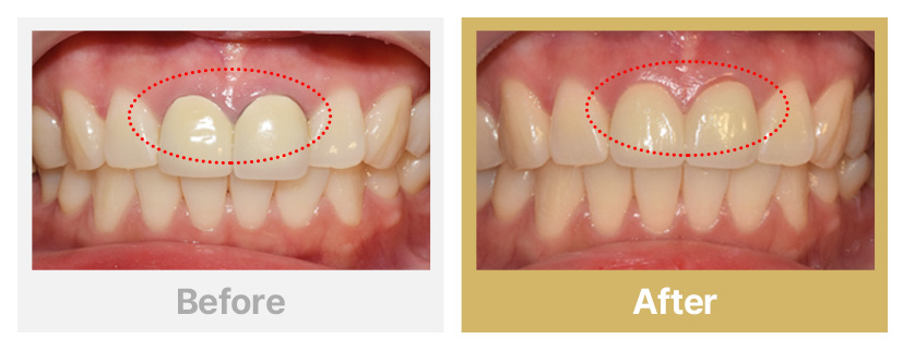 9.오래된 PFM 올세라믹으로 교체