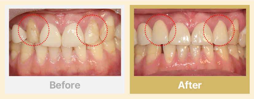10. 보기싫은 앞니 올세라믹으로 자연스럽게