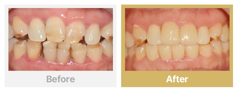 11.심한 마모치아 치료