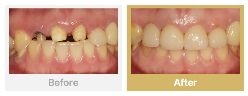 기존 보철물 탈락으로 올세라믹 재제작