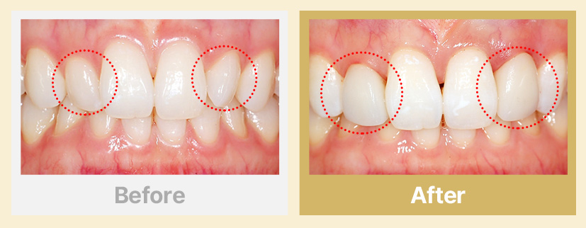 4.유난히 작은 치아(왜소치)