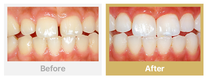 5.라미네이트+미백치료