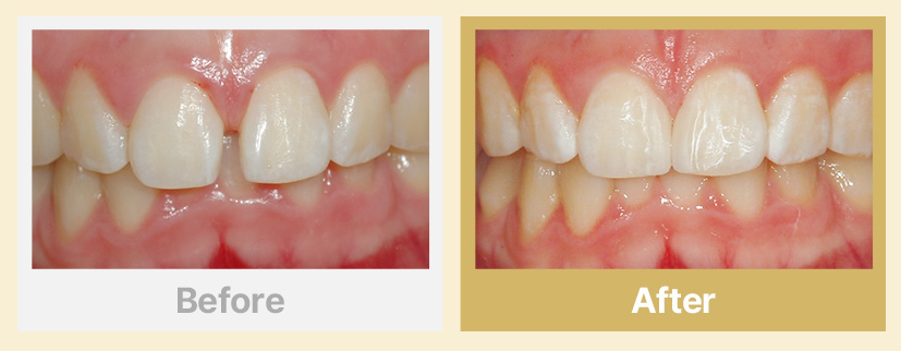 6.부분 라미네이트