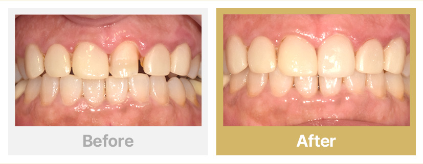7.기존 라미네이트 탈락 재제작