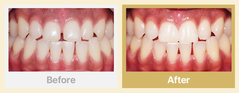 8.벌어진 앞니 치료