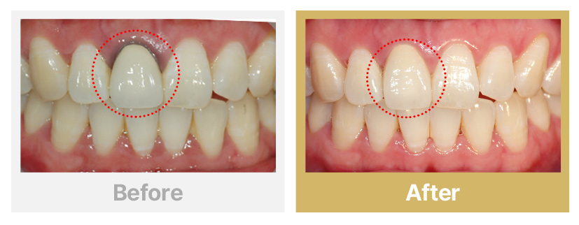 1.오래된 PFM을 지르코니아로 교체