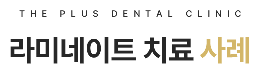 라미네이트 치료 사례