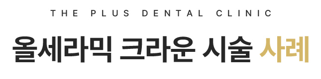 올세라믹 치료 사례